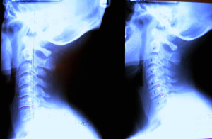 neck-before-after-xray